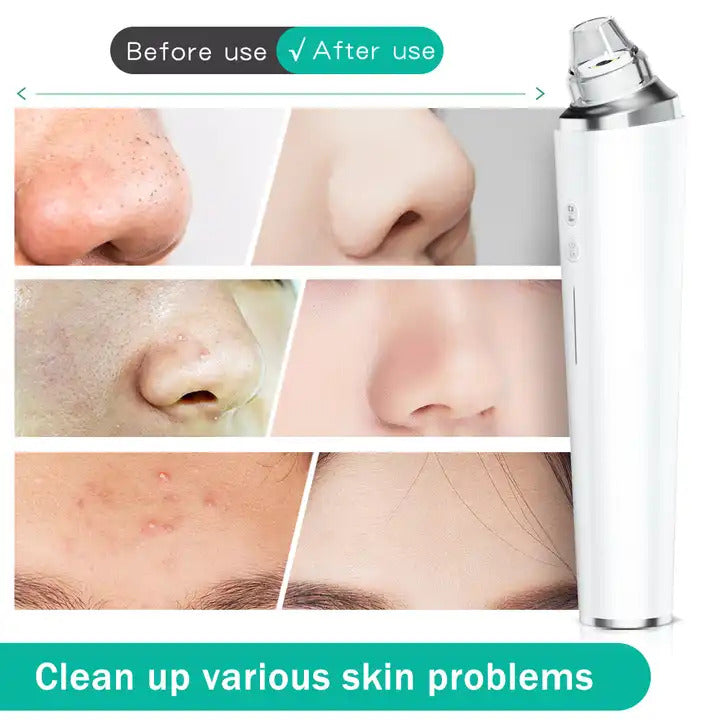 Blackhead remover with app camera is easy to use